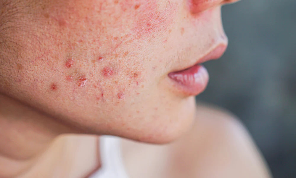 Das Wichtigste über Akne-Rosacea