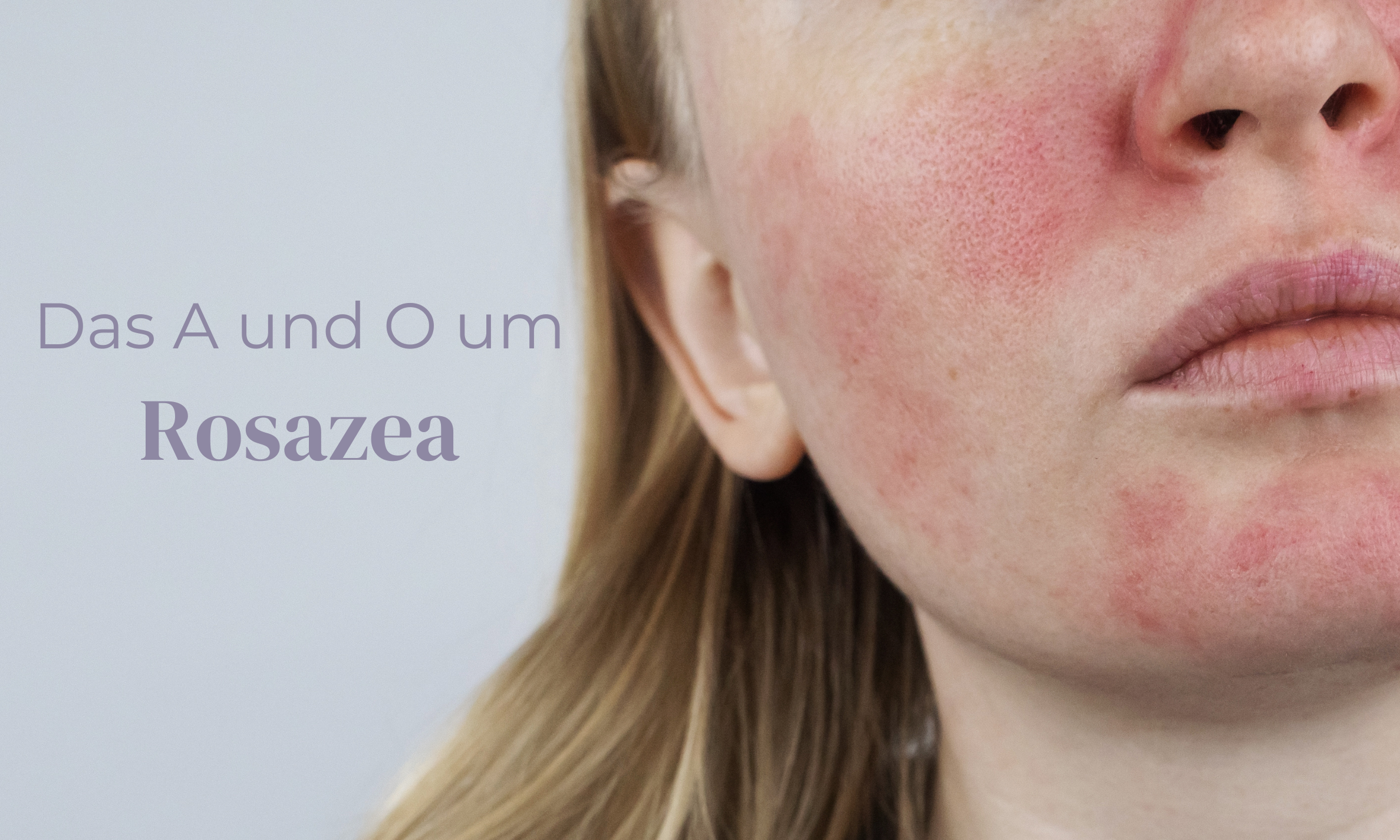 Das A & O der Rosazea Fakten